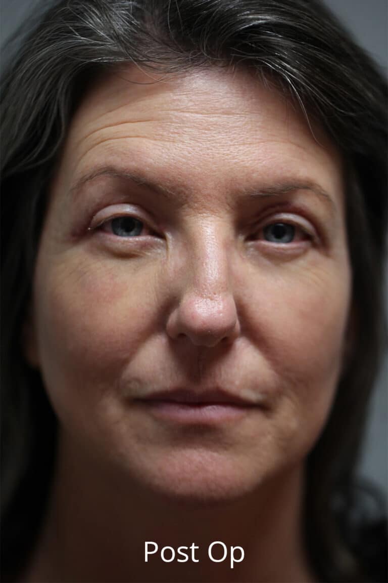 After Image: Upper Blepharoplasty - front