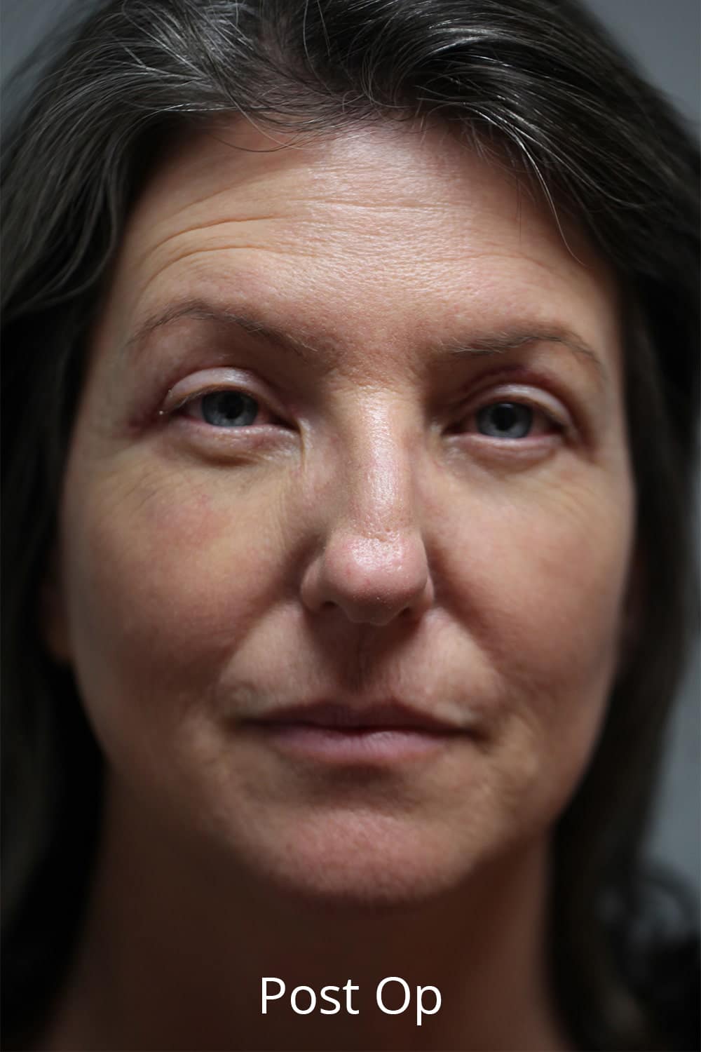 After Image: Upper Blepharoplasty - front