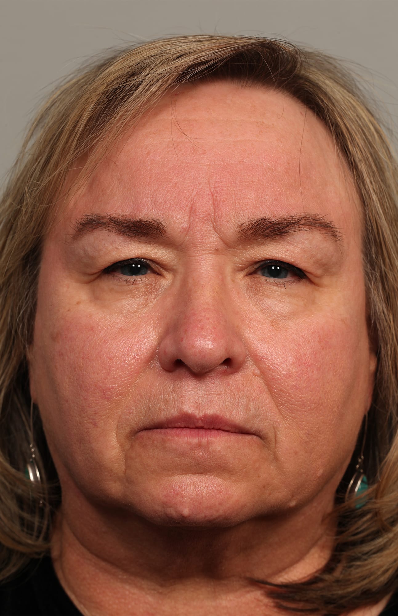 Before Image: Upper and lower lid blepharoplasty with laser resurfacing to the lower lids - front