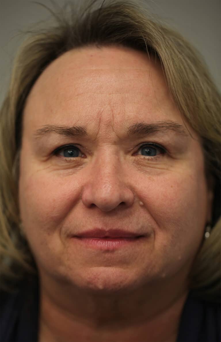 After Image: Upper and lower lid blepharoplasty with laser resurfacing to the lower lids - front