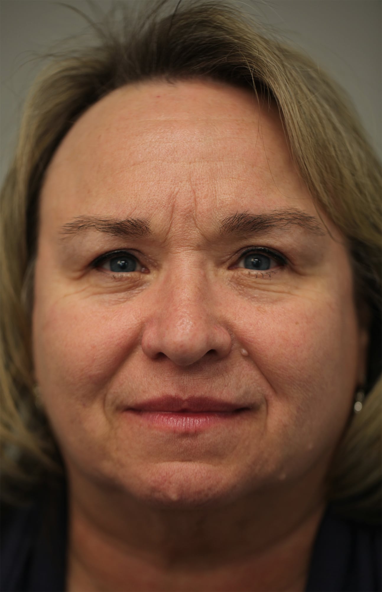 After Image: Upper and lower lid blepharoplasty with laser resurfacing to the lower lids - front