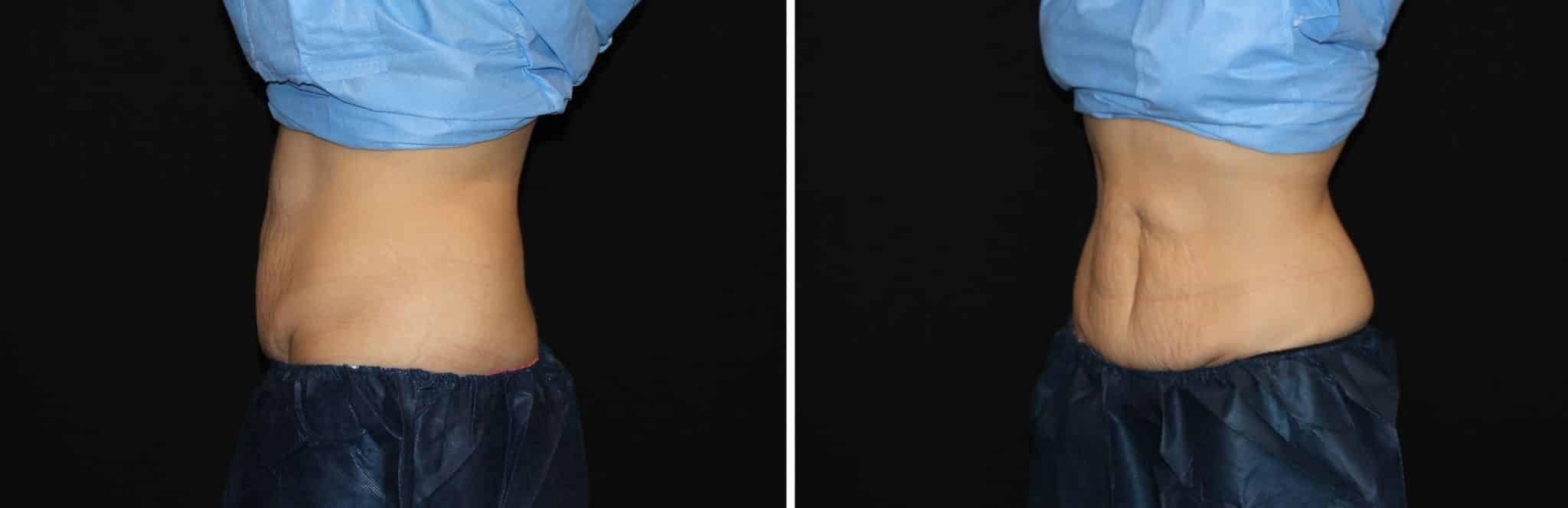 before and after coolsculpting Aurora CO