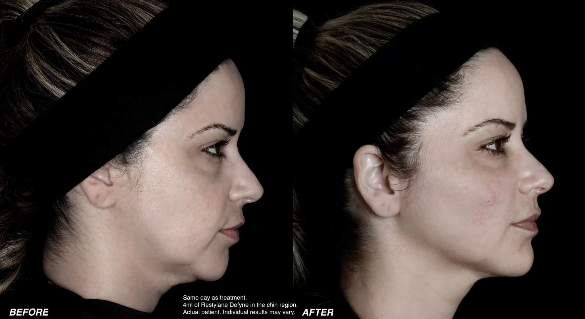 before and after Restylane® Aurora CO
