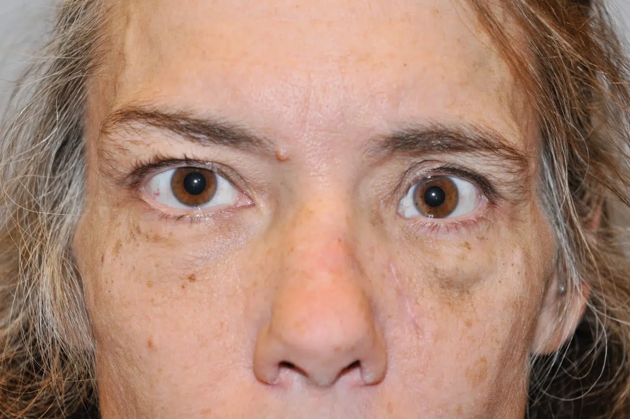 before 3D Facial Implants Denver CO