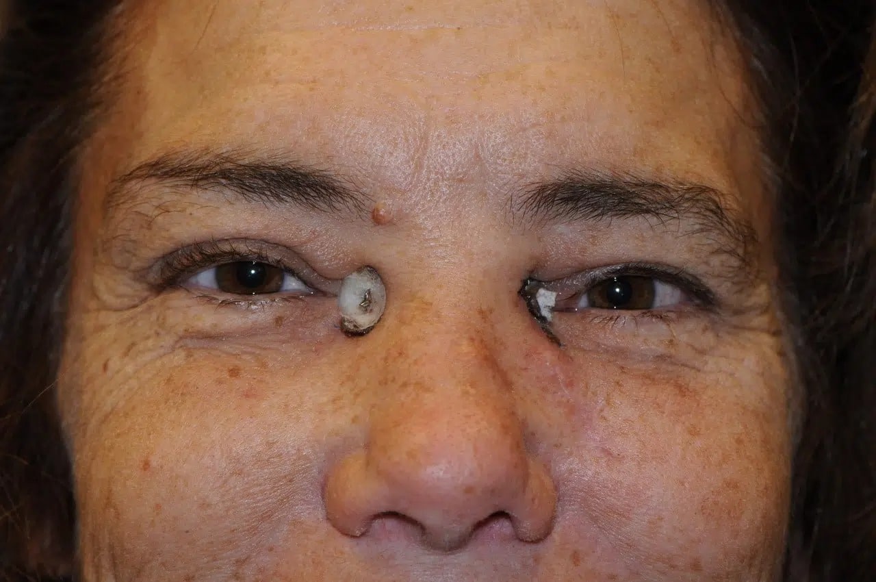 during 3D Facial Implants treatment Denver CO