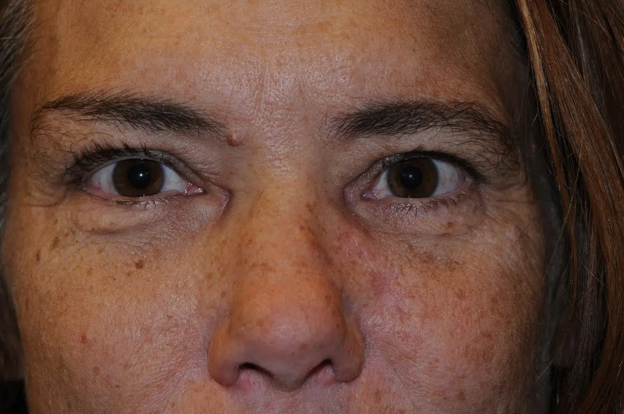 after 3D Facial Implants Denver CO