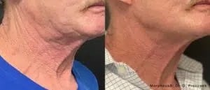 before and after Morpheus8 Aurora CO