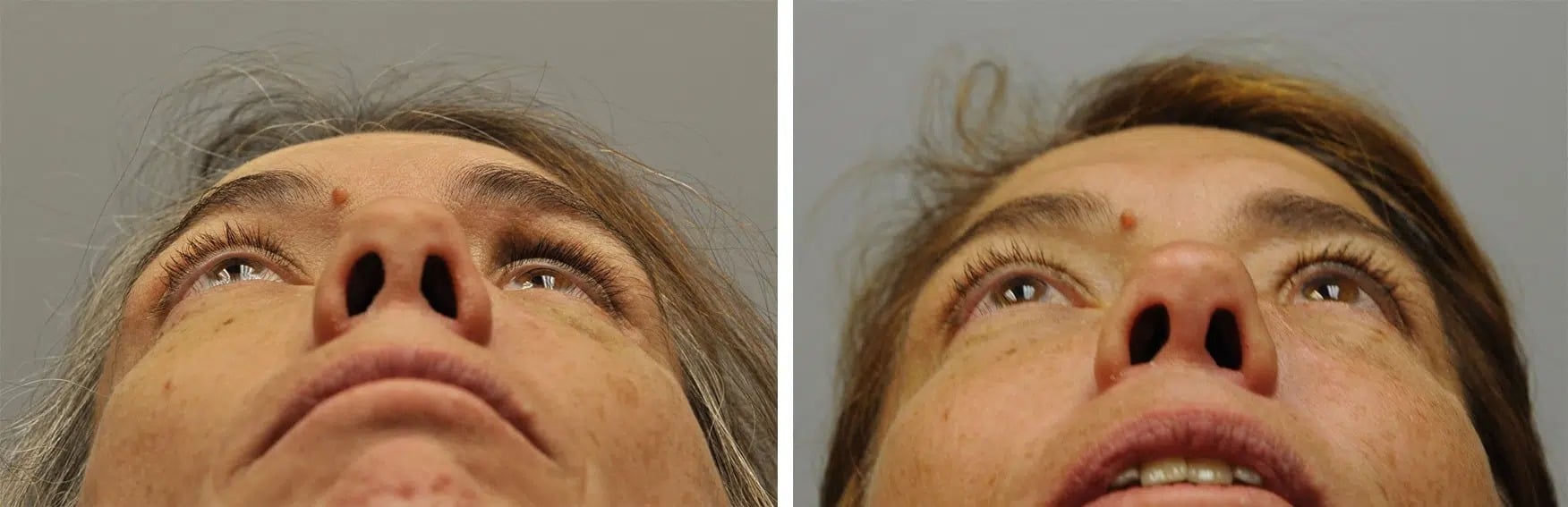 before after 3D Facial Implants Denver CO