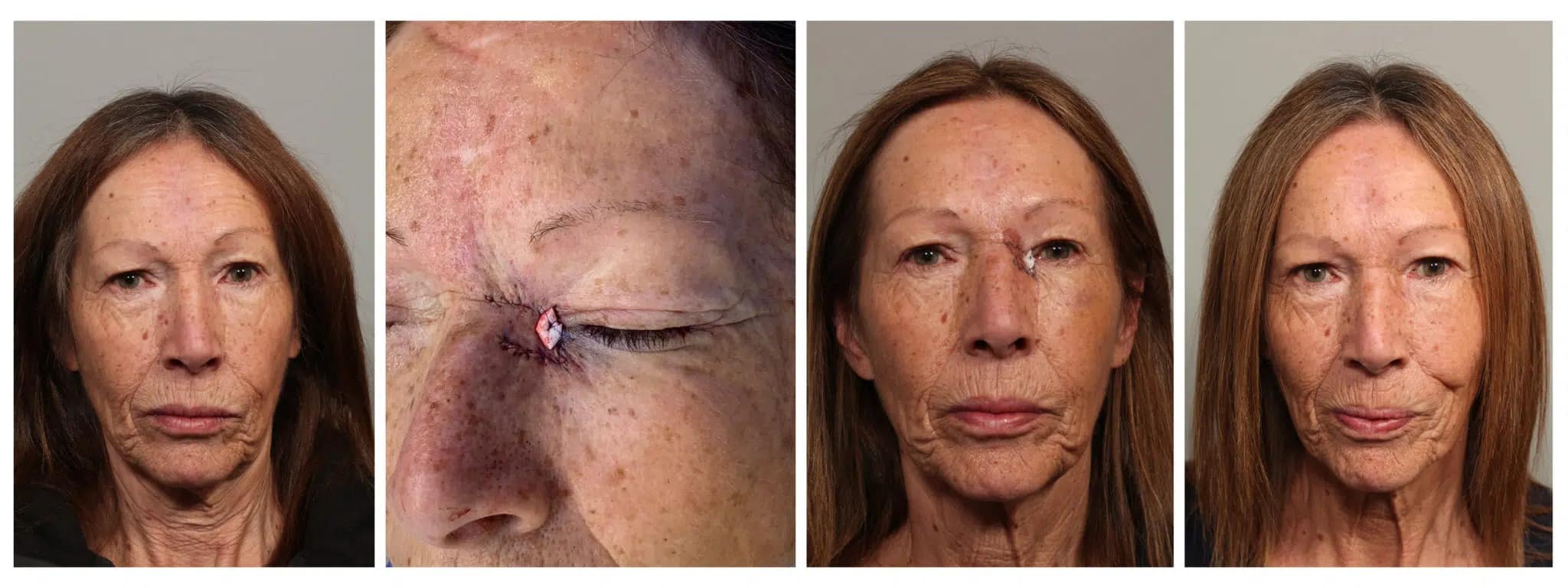 female patient with basal carcinoma on eye before and after removal