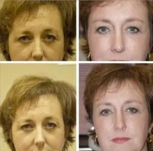 forehead lift Denver CO