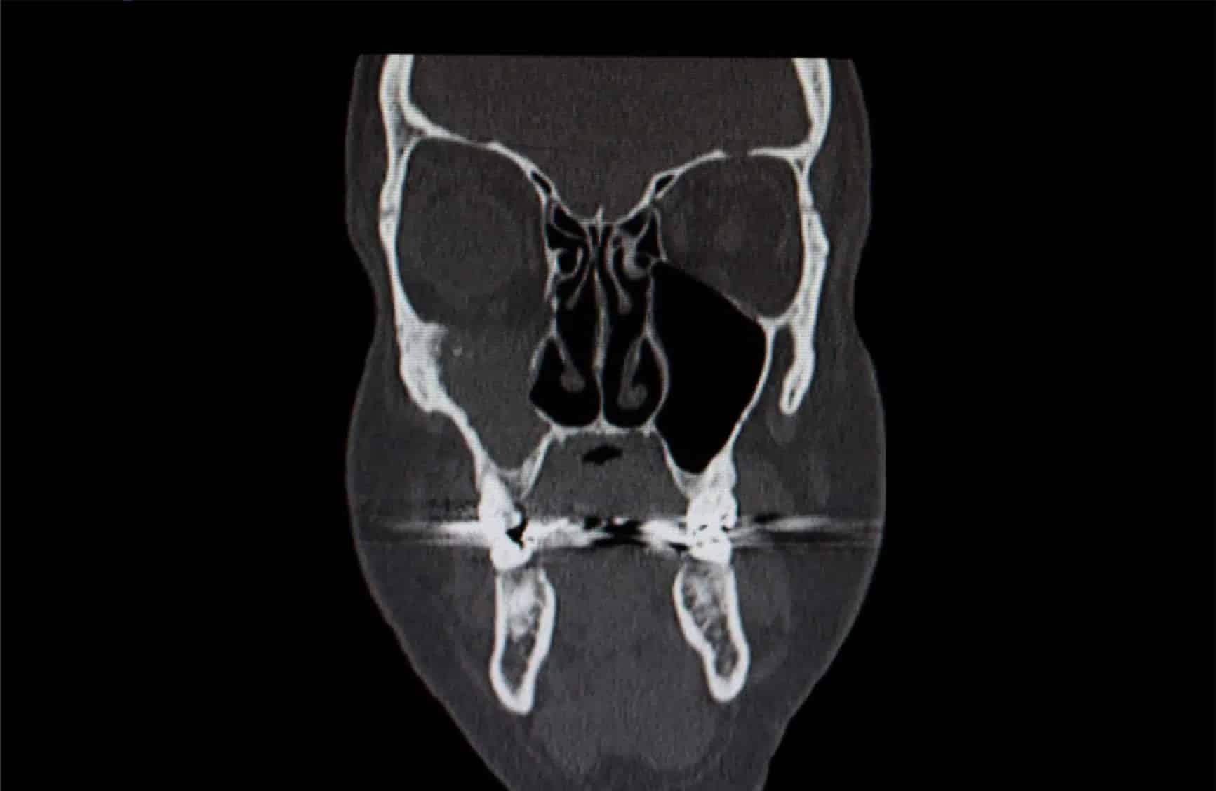 CT scan for 3D Facial Implants Aurora CO