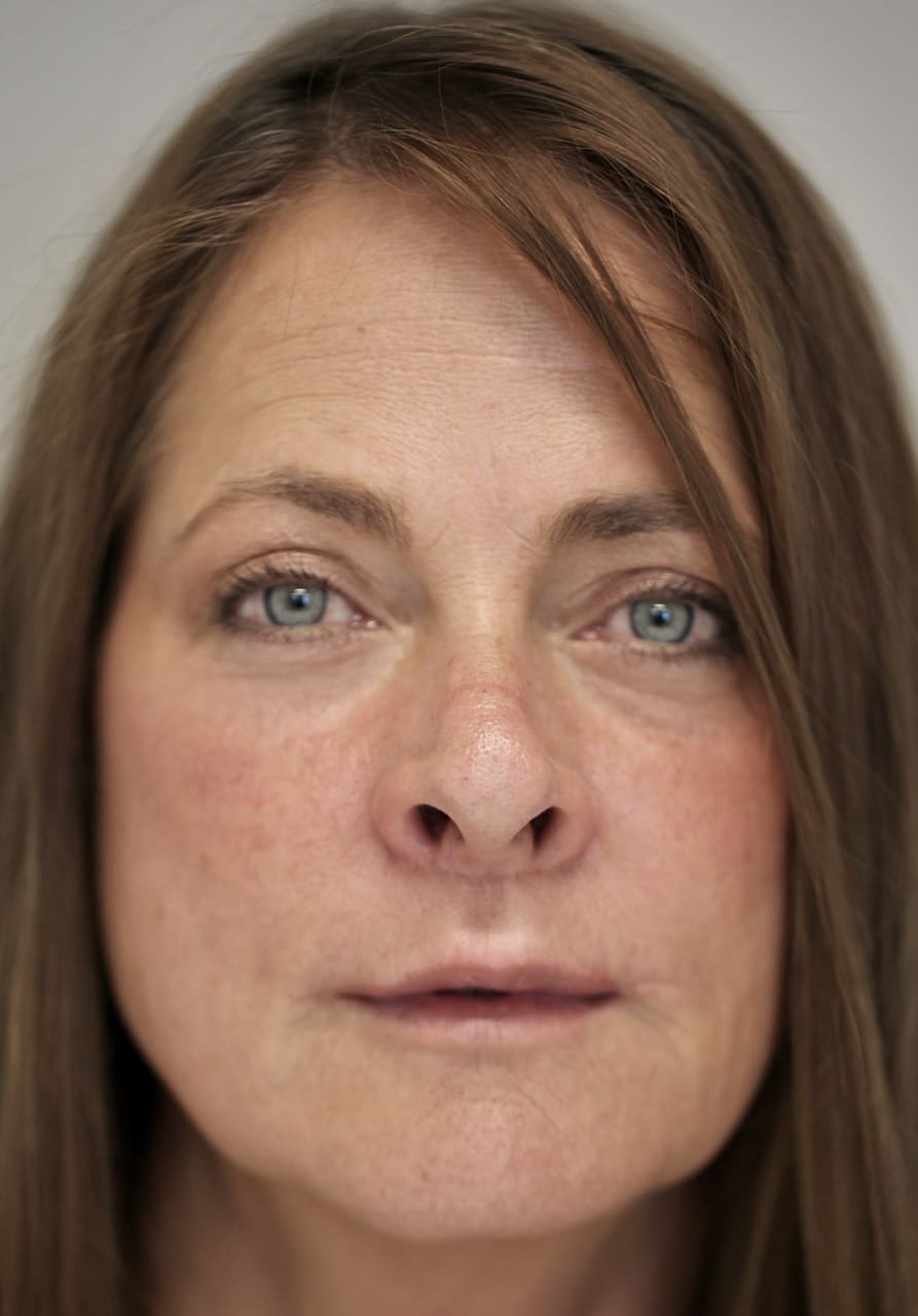 Patient 1 - after
