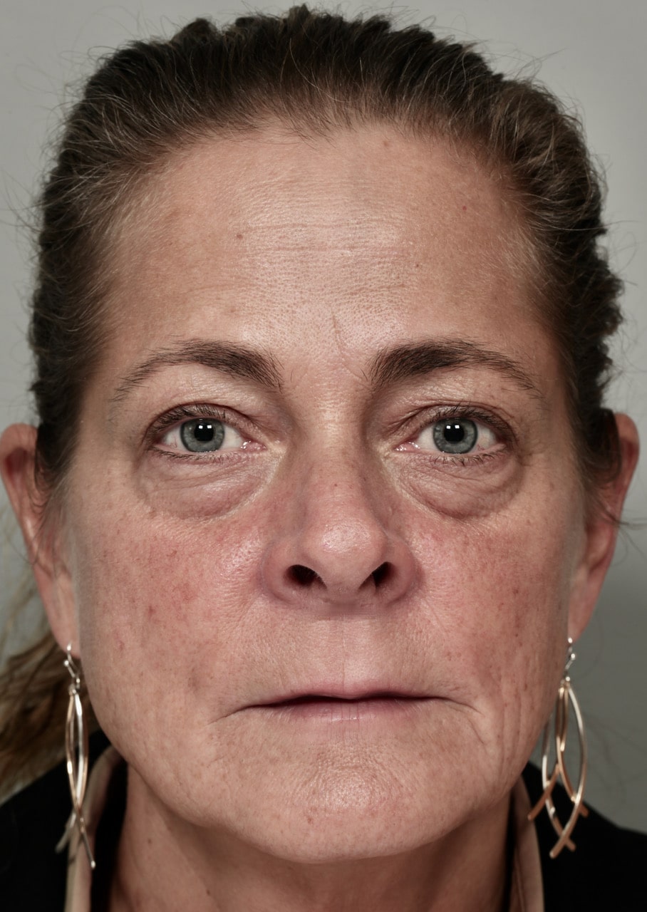 Patient 1 - before