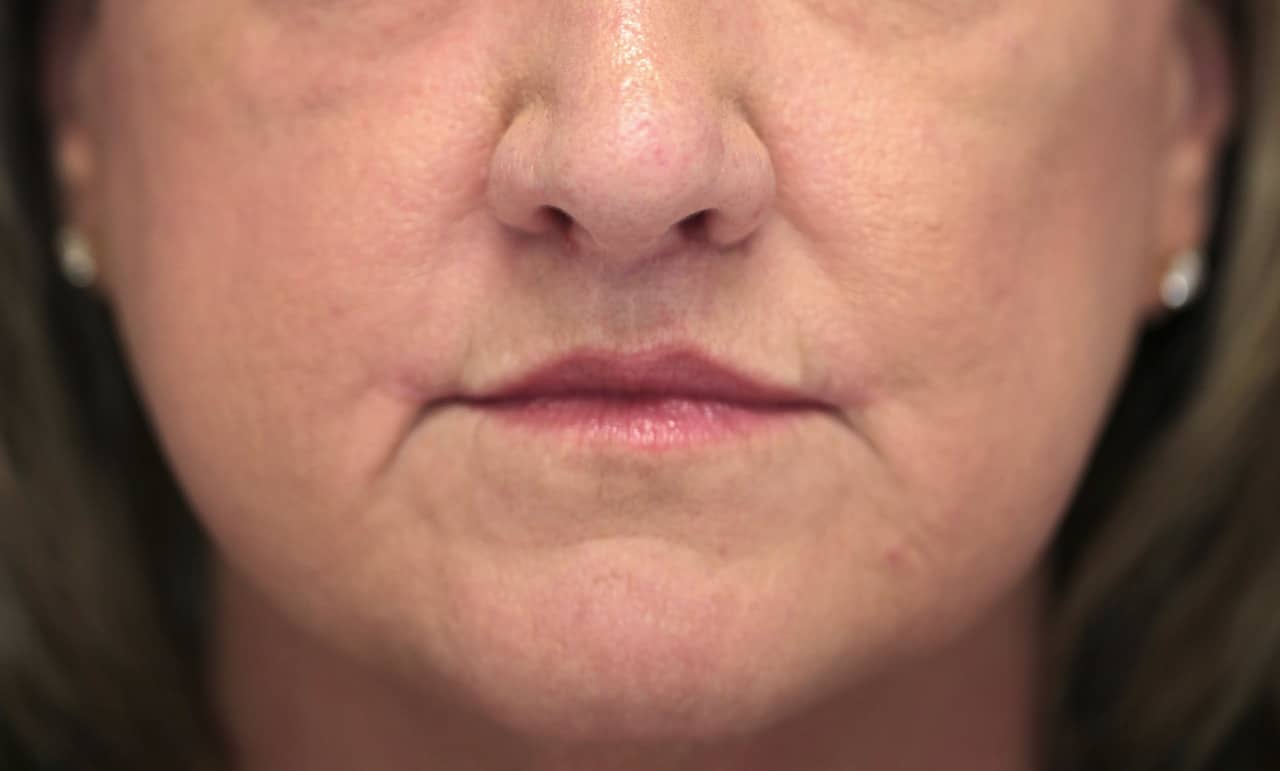 Patient 3 - after