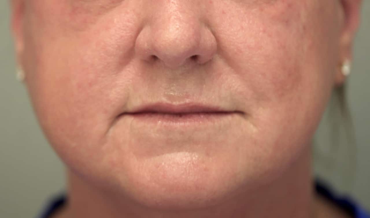 Patient 3 - before