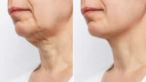 Woman before and after facelift and neck lift in Denver