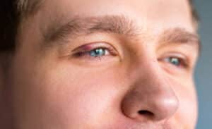 Man with eyelid bump in Denver, CO