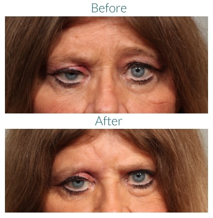 before and after Orbital Tumor Repair Denver CO