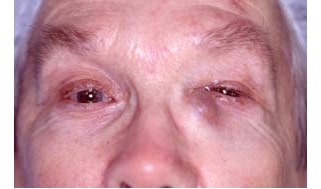 Watery Eye Treatment Greenwood Village CO