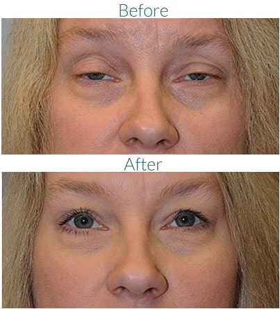 before and after Eyelid Ptosis Surgery Greenwood Village CO