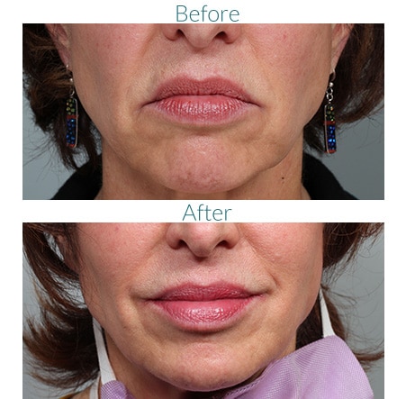 before and after BOTOX Cosmetic Injection Greenwood Village CO