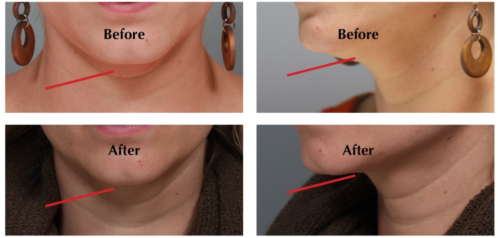 before and after Kybella Greenwood Village CO
