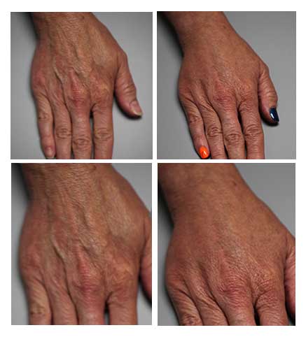 Before and After Hand Rejuvenation Greenwood Village CO