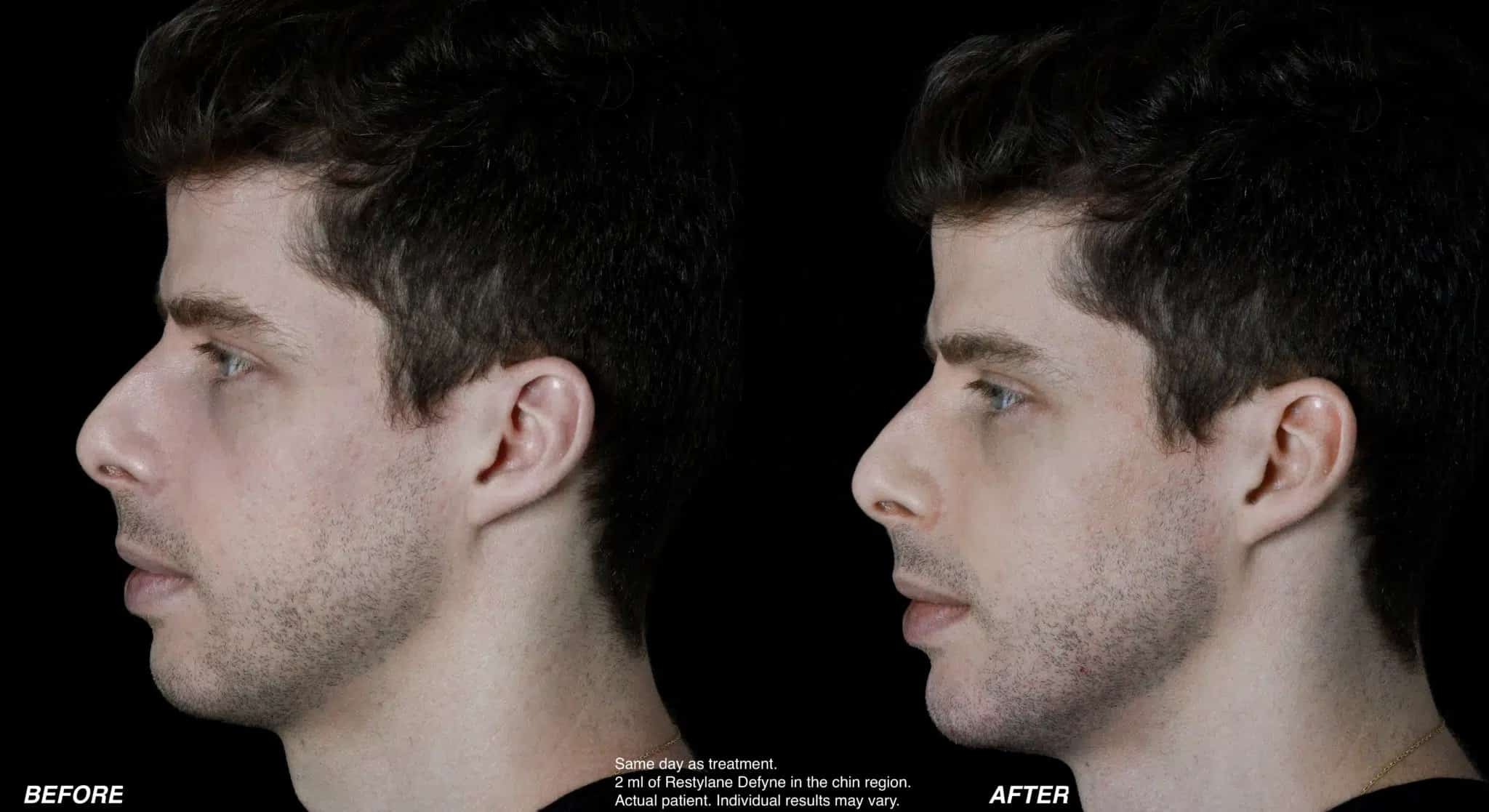 before and after Restylane® Denver CO