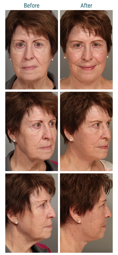 before and after facial surgery Greenwood Village CO