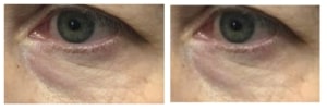1783637696_Untitled-6-300x101-1-1 before and after Accutite Skin Tightening Treatment Denver CO