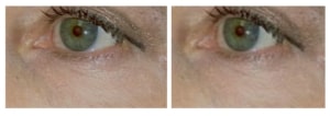 1783637699_Untitled-7-300x106-1-1 before and after Accutite Skin Tightening Treatment Greenwood Village CO