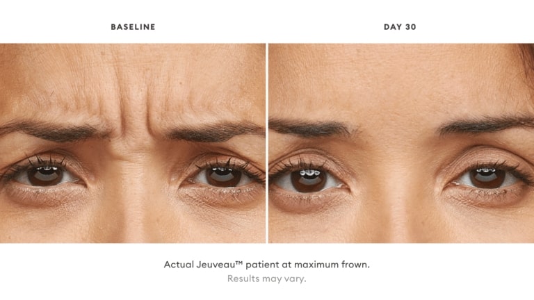 before and after botox treatment Denver CO