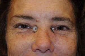 during 3D Facial Implants treatment Denver CO