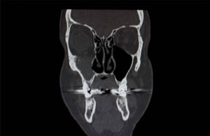 CT scan for 3D Facial Implants Greenwood Village CO