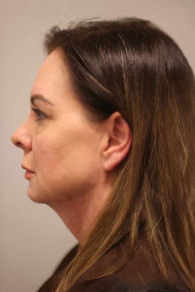 Before Image: Fat Transfer, Facelift - left-side