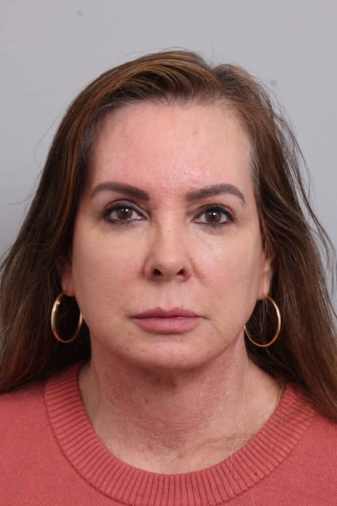 After Image: Fat Transfer, Facelift - front