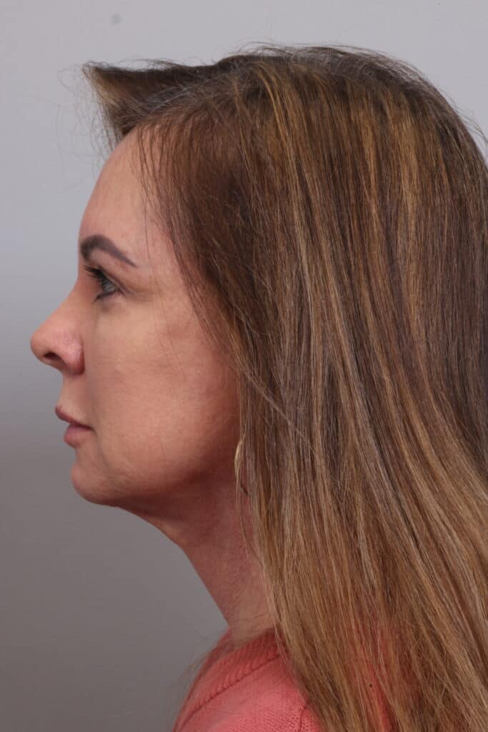 After Image: Fat Transfer, Facelift - left-side