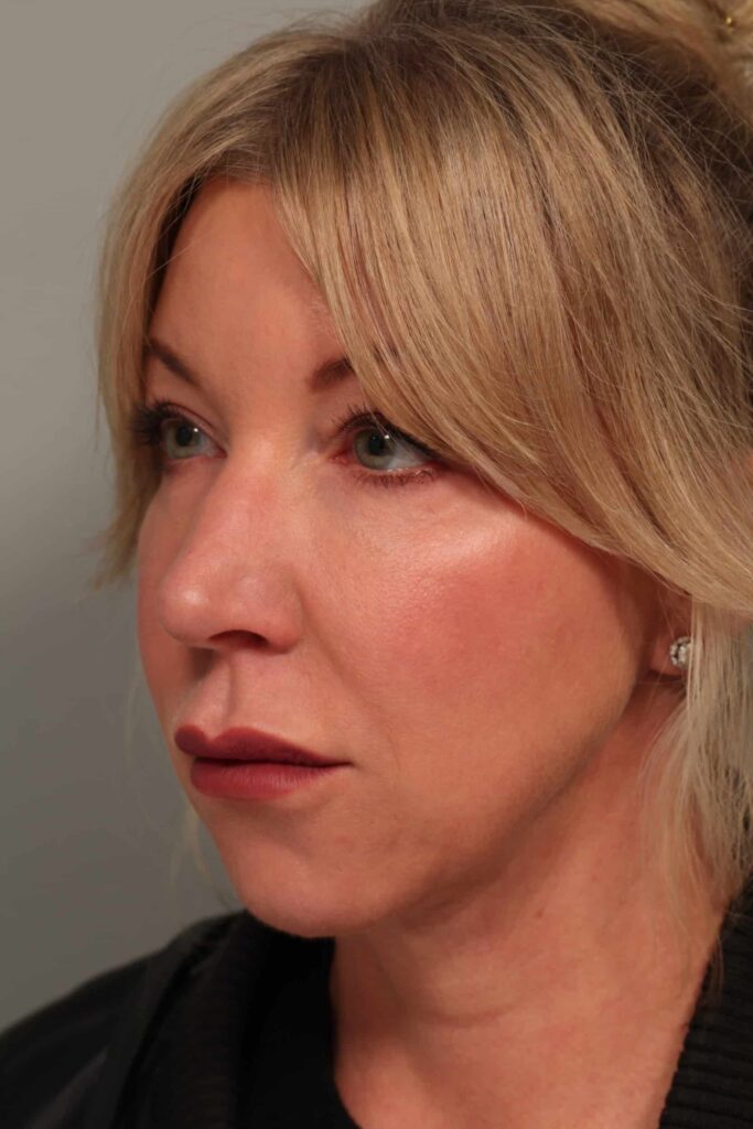 54-After-angle-facetite-neck-lipo-Morpheus8-Restylane-lower-lids-scaled
